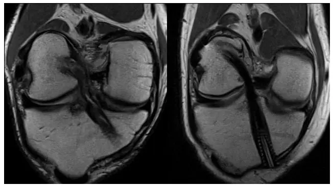 ACL 6 months vs 10 months